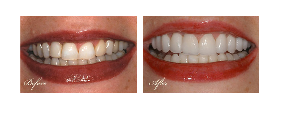 before and after dental image