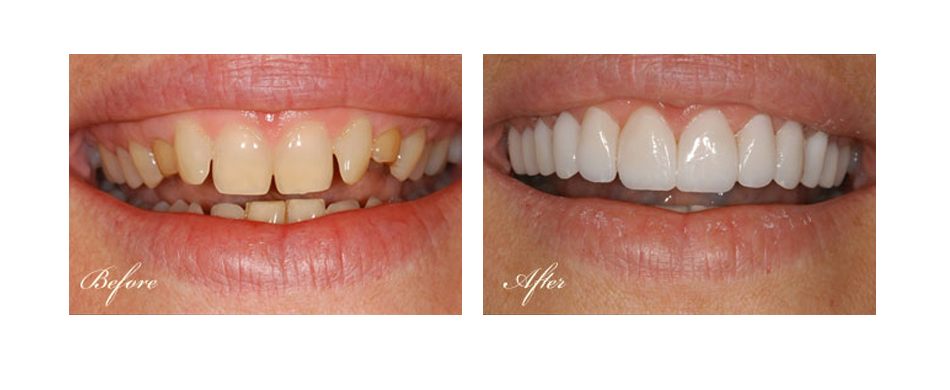 before and after dental image