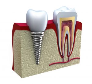 dental implants 