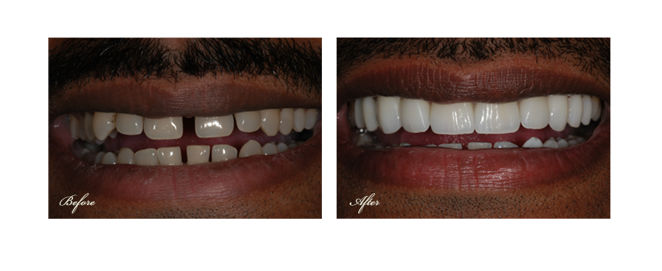 before and after dental image