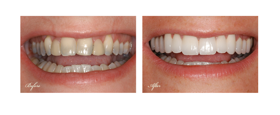 before and after dental image