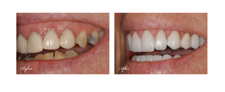 before and after dental image