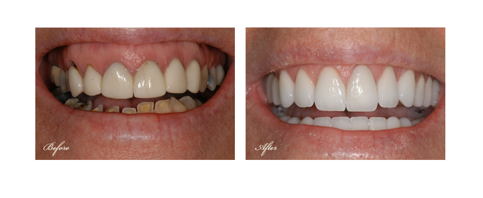 before and after dental image