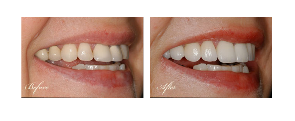 before and after dental image