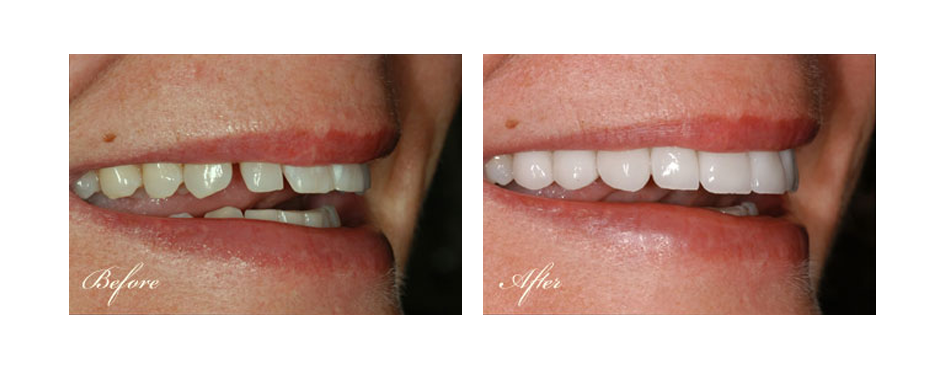 before and after dental image