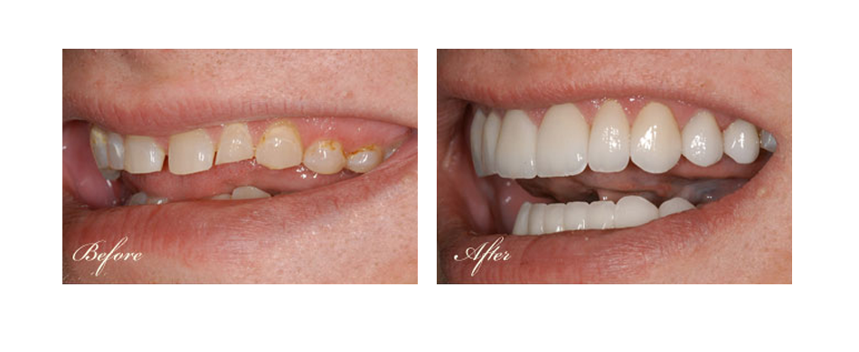 before and after dental image