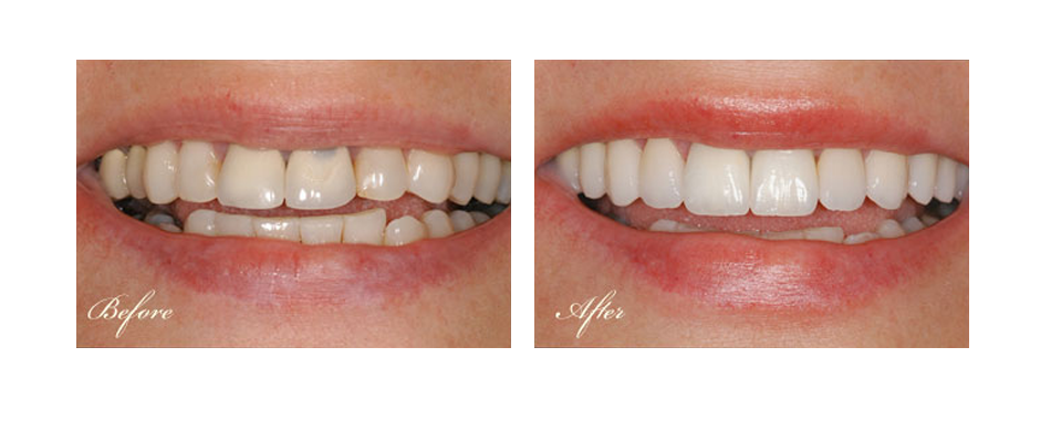 before and after dental image