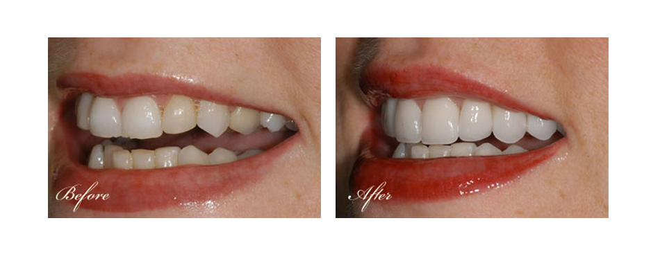 before and after dental image