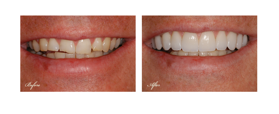 before and after dental image