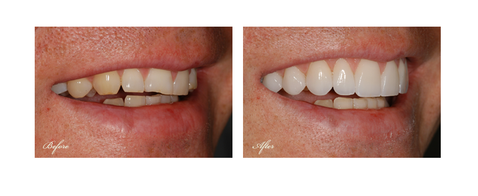 before and after dental image