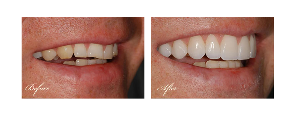 before and after dental image