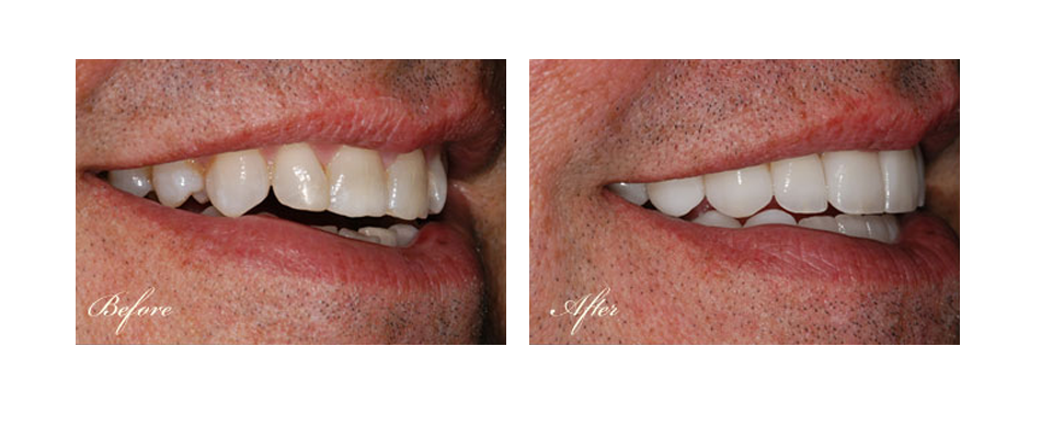 before and after dental image