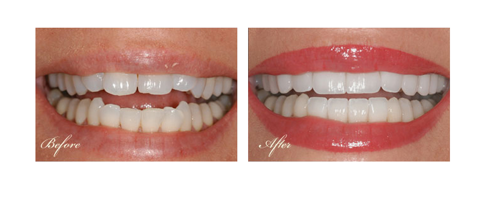 before and after dental image