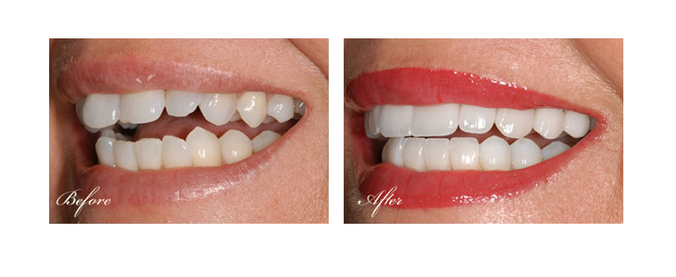 before and after dental image
