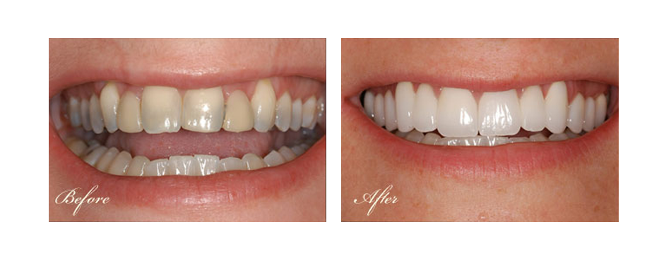 before and after dental image