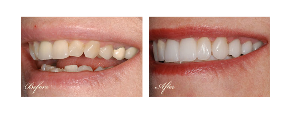 before and after dental image