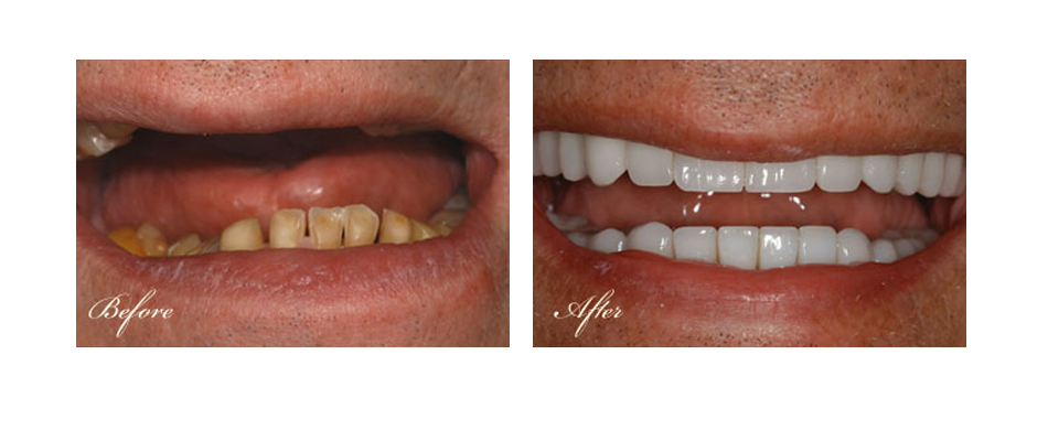 before and after dental image