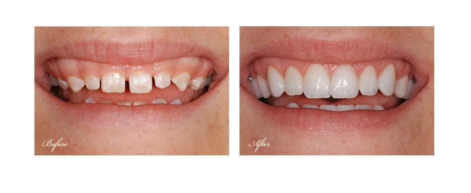 before and after dental image