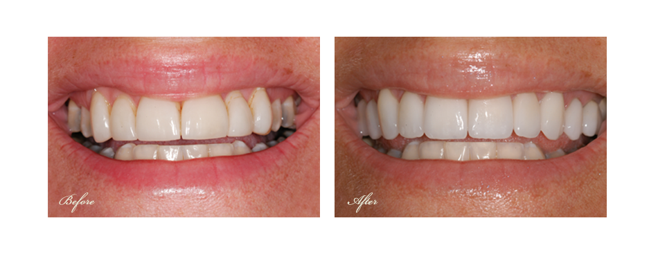 before and after dental image