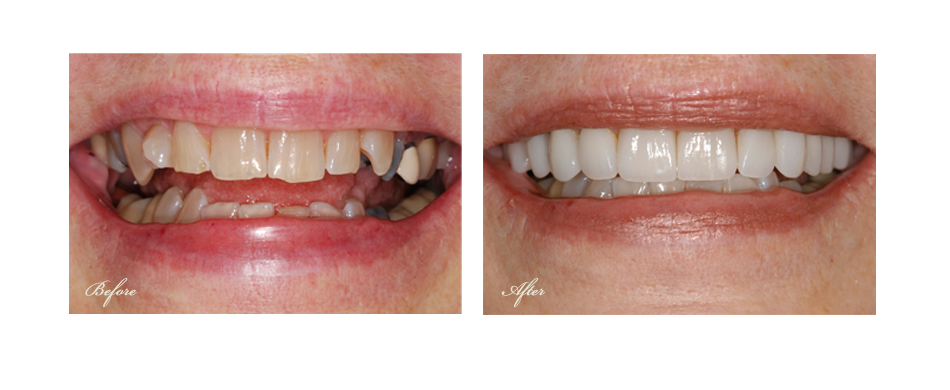 before and after dental image