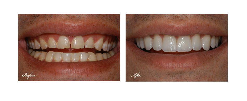 before and after dental image