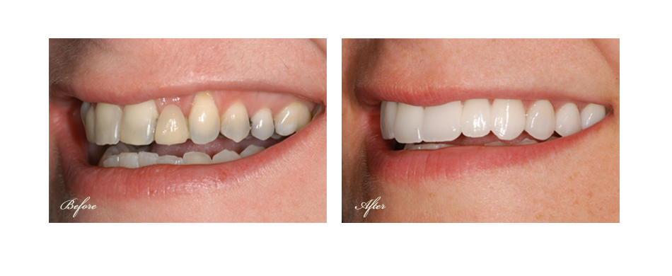 before and after dental image