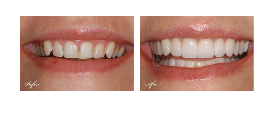 before and after dental image