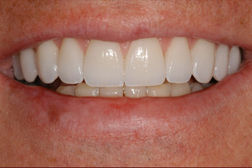 restorative dentistry indianapolis